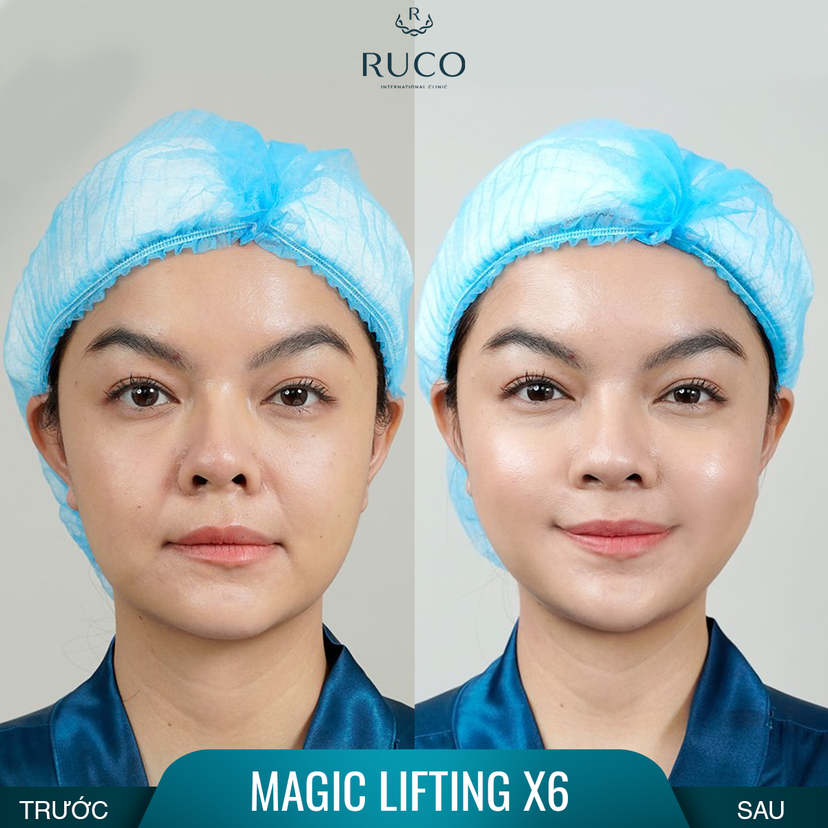 before after magic lifting x6 pham quynh anh