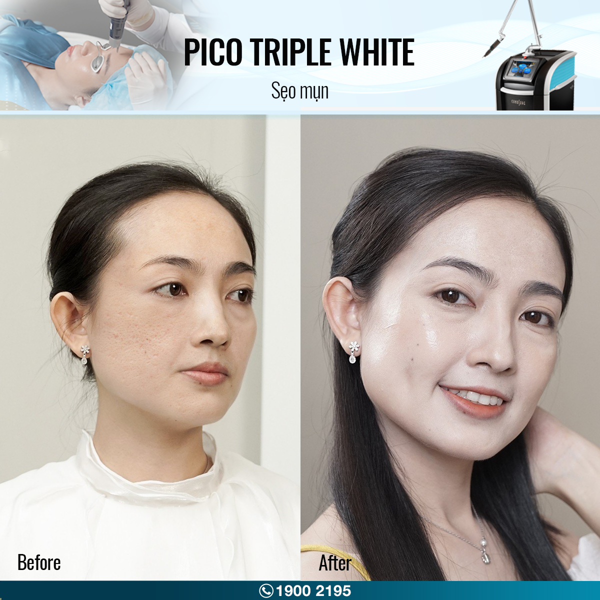 before after pico triple white trị sẹo 