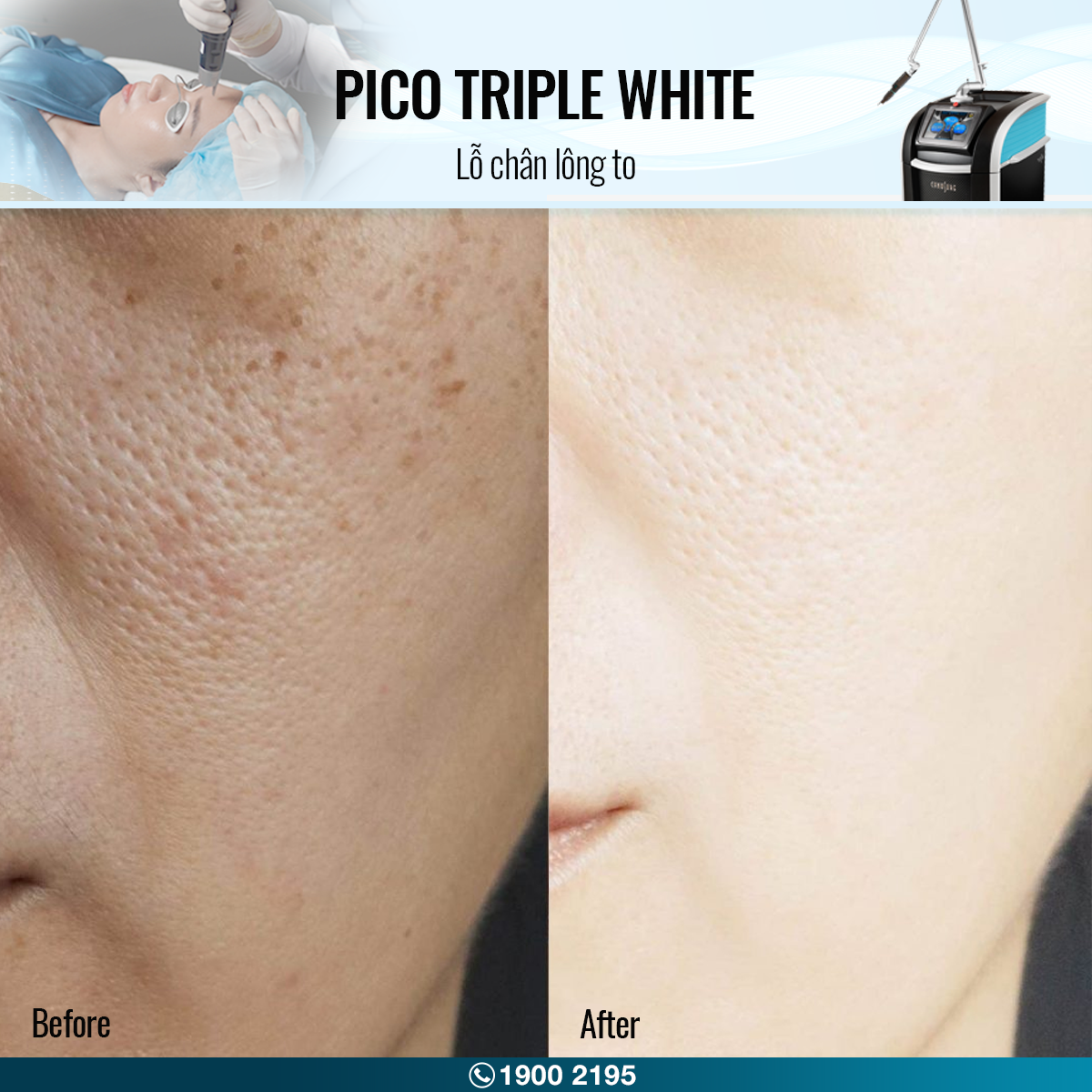 before after pico triple white lỗ chân lông to