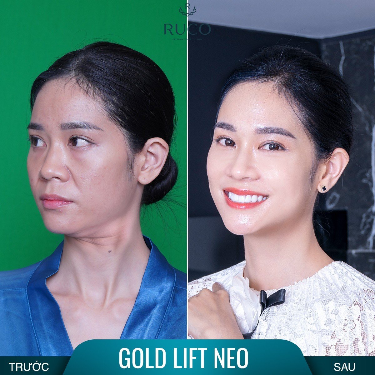 chị hồng phước before after ruco gold lift neo