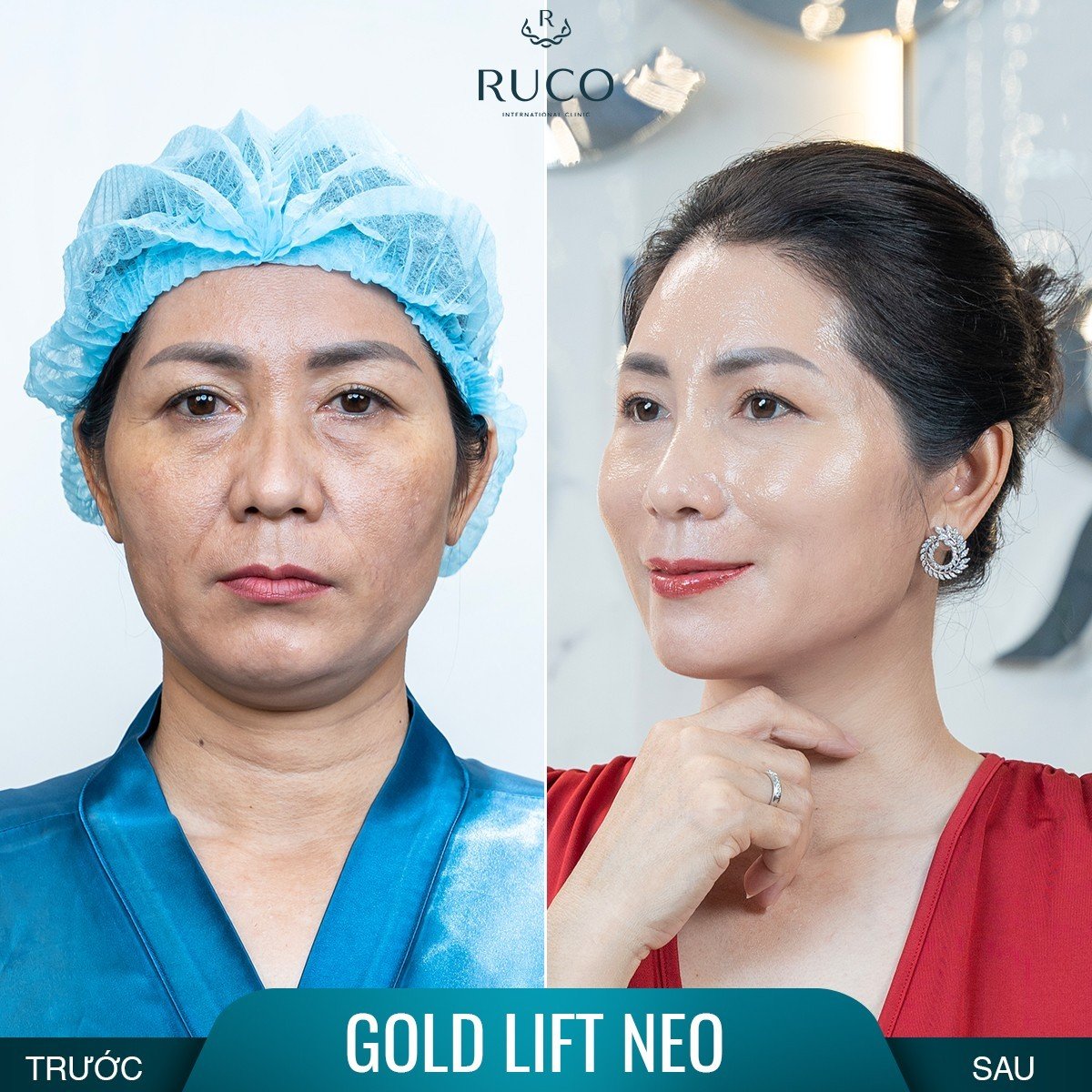 chị mai before after gold lift neo ruco