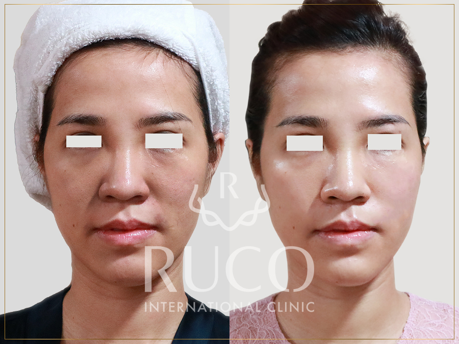 ruco international clinic công nghệ young lifting 360 hình ảnh thực tế của khách hàng