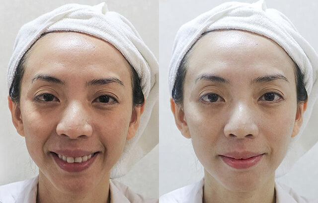 before after ultra thermage của ca sĩ thu trang