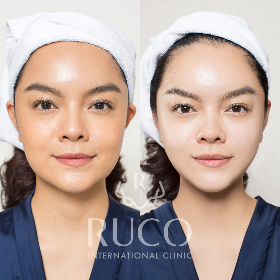before after phạm quỳnh anh thermage flx