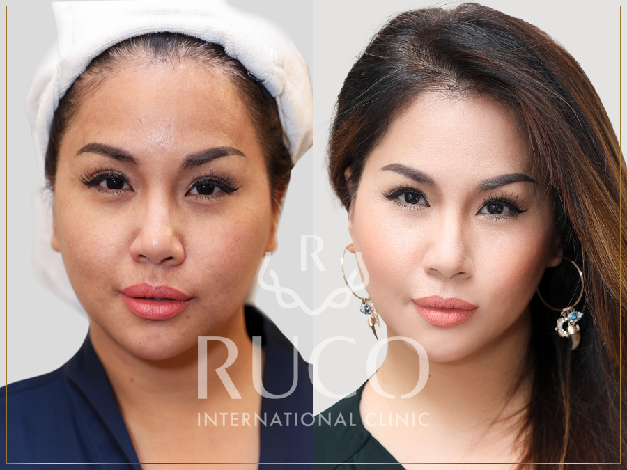 ruco beauty back minh tuyết before after