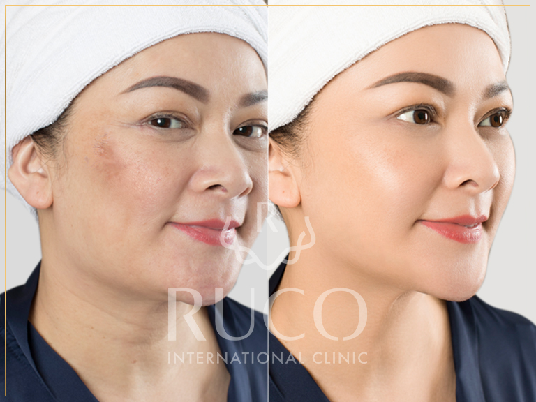 before after ultherapy ngăn ngừa lão hóa