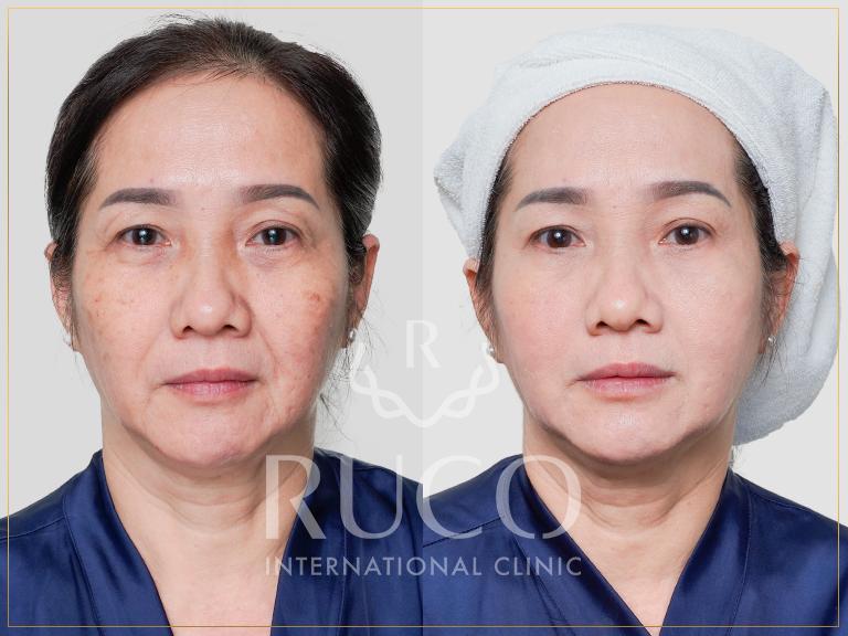 Hình ảnh khách hàng trước và sau khi điều trị nám với công nghệ Detox Menalin