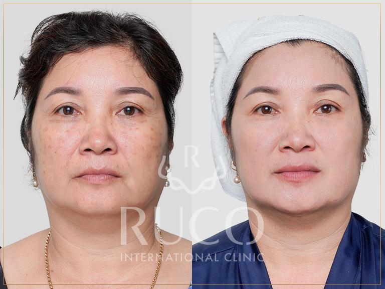 Hình ảnh khách hàng trước và sau khi điều trị nám