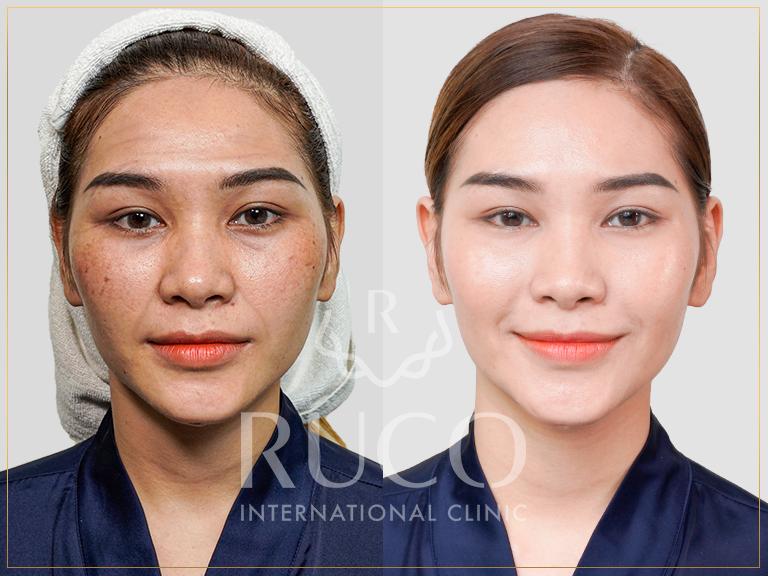 before after trẻ hóa sau sinh thermage flx