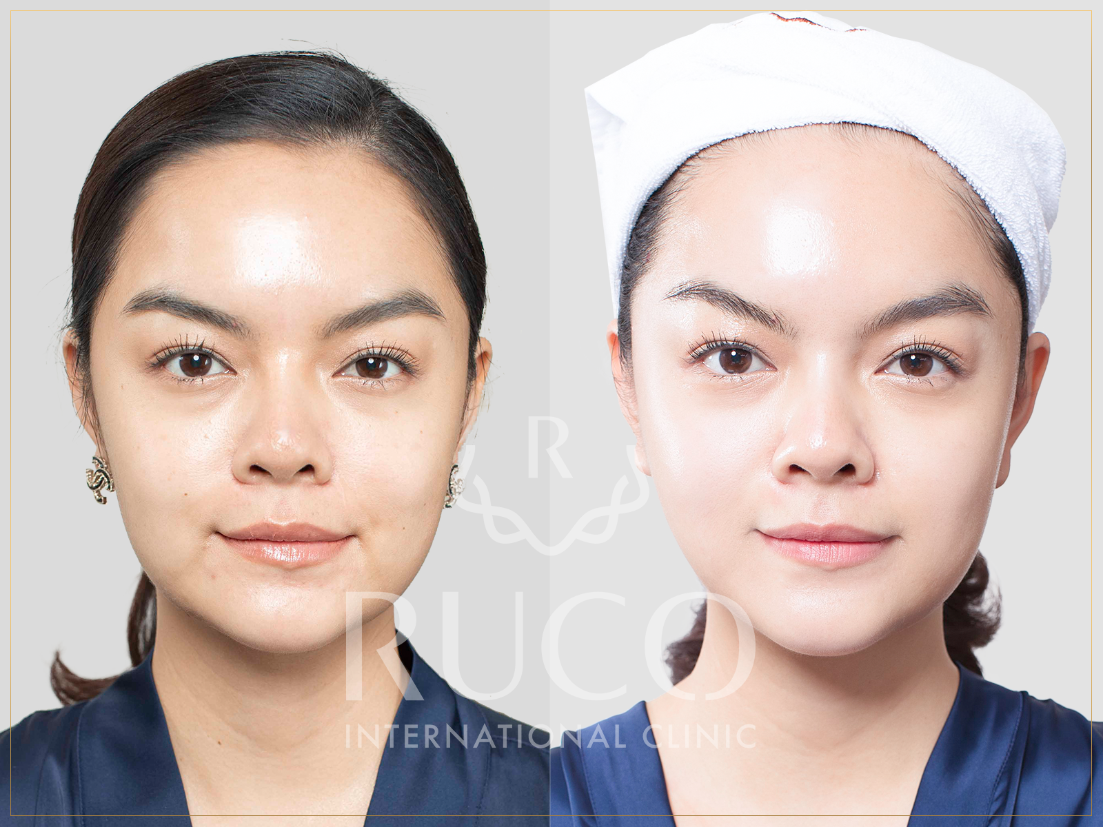 Phạm Quỳnh Anh luôn lựa chọn RUCO International clinic để bảo hành sắc đẹp bản thân.