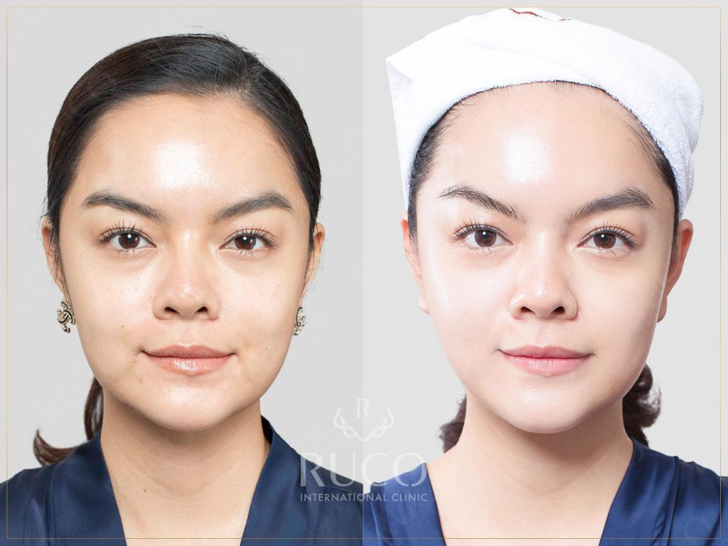 sao việt ca sĩ phạm quỳnh anh before after ultherapy