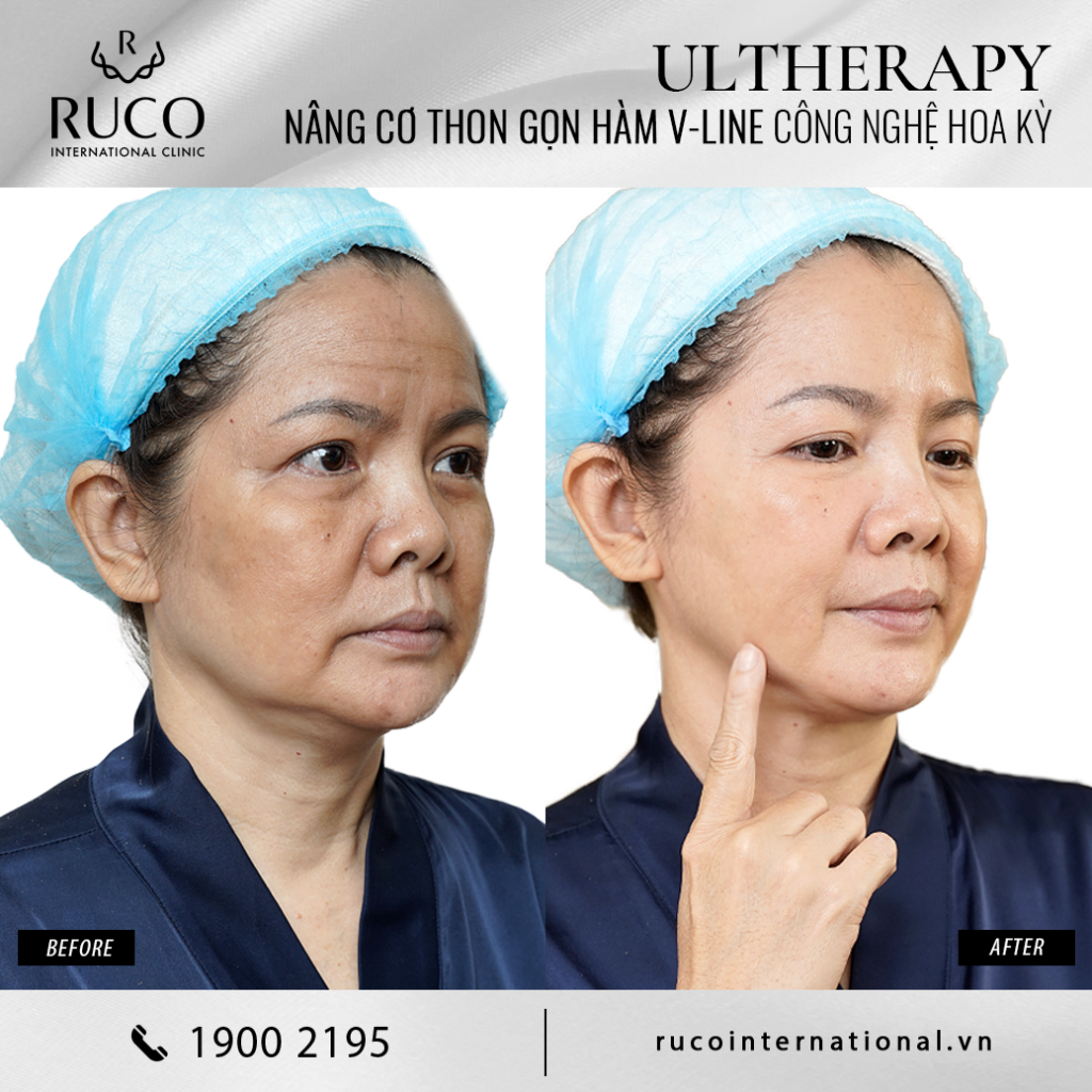 làm gọn mặt ultherapy before after