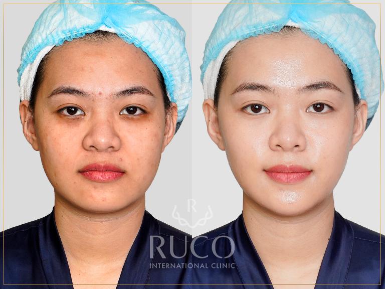Hình ảnh trước và sau khi chăm sóc da với Bolus Tảo Đỏ