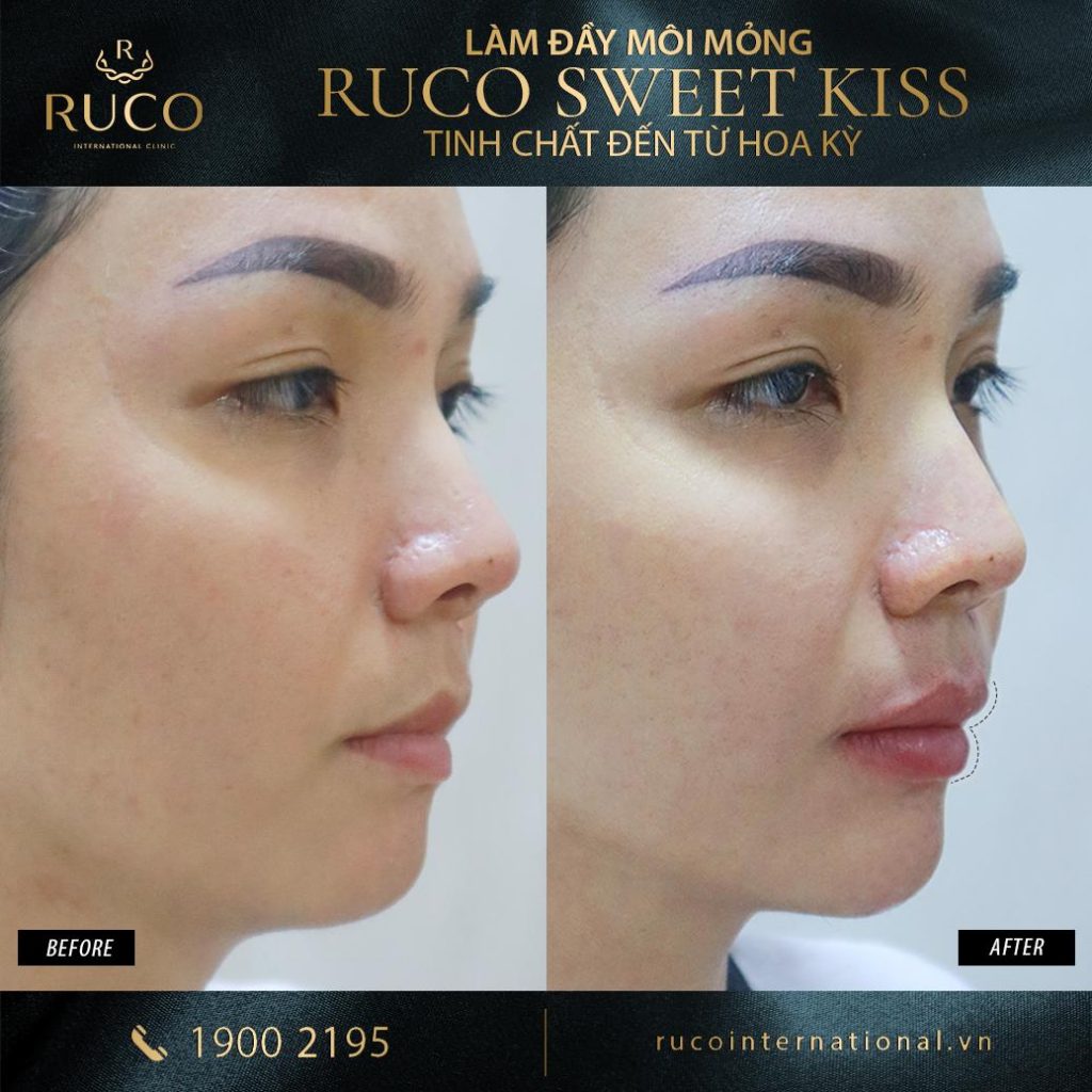 before after tiêm filler ruco sweet kiss