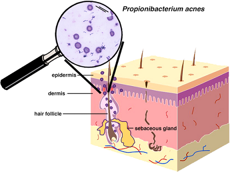 detox acnes đặc trị mụn tây ban nha cơ chế
