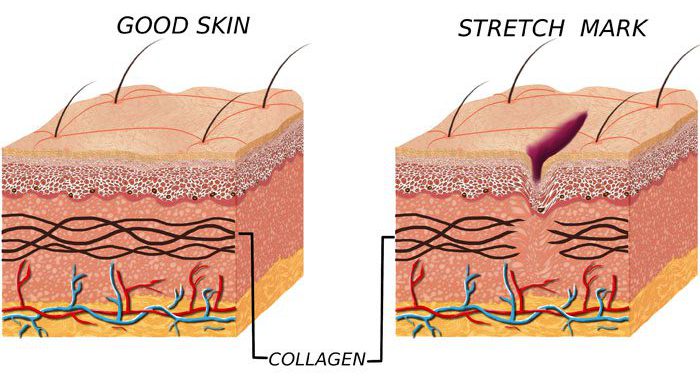 cấu trúc da bị rạn sau sinh và da bình thường