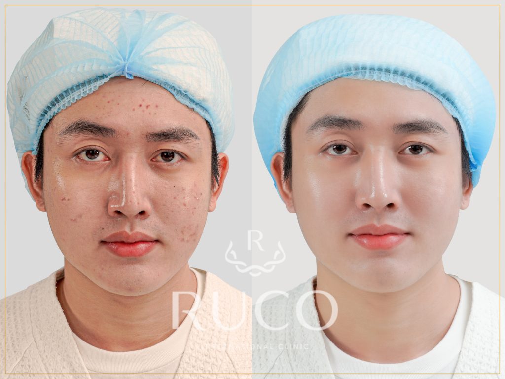 phác đồ điều trị mụn detox acnes 360 before after