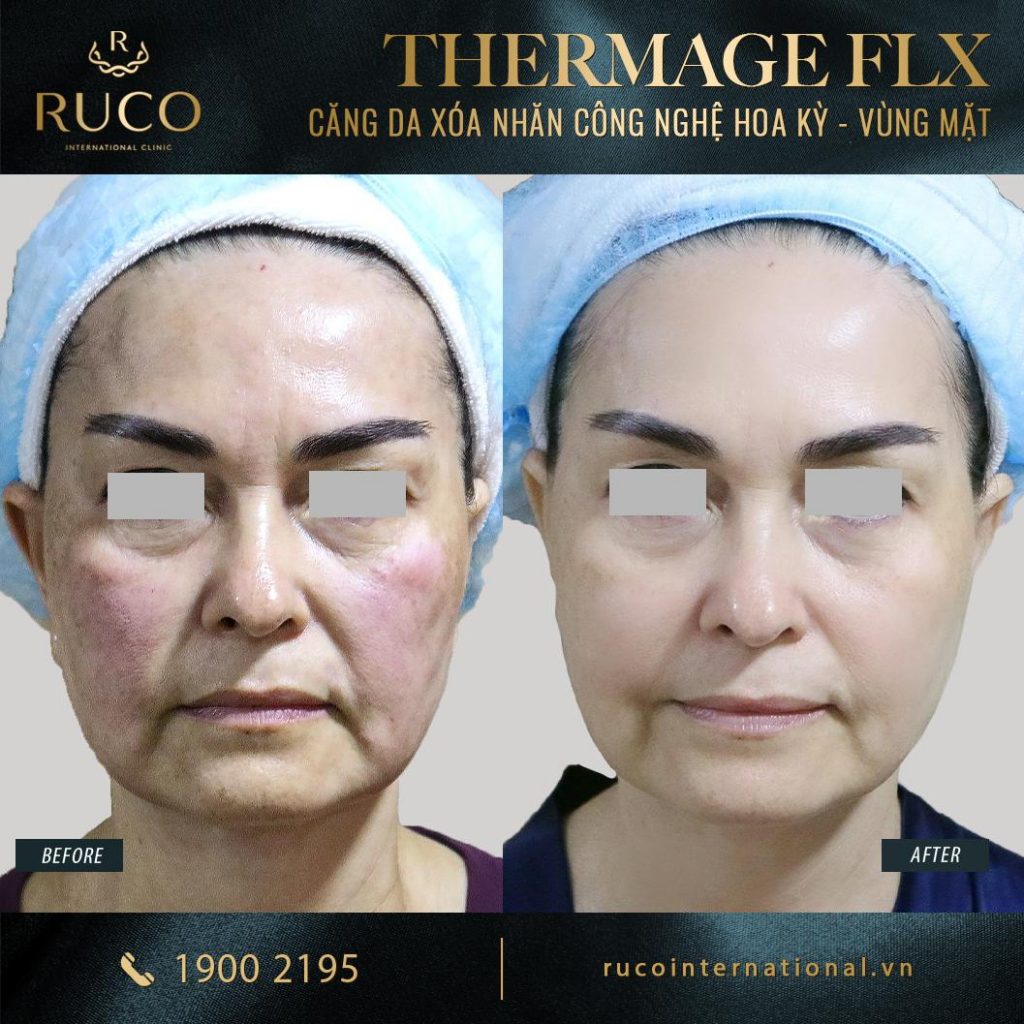 thermage mặt thermage flx công nghệ hoa kỳ