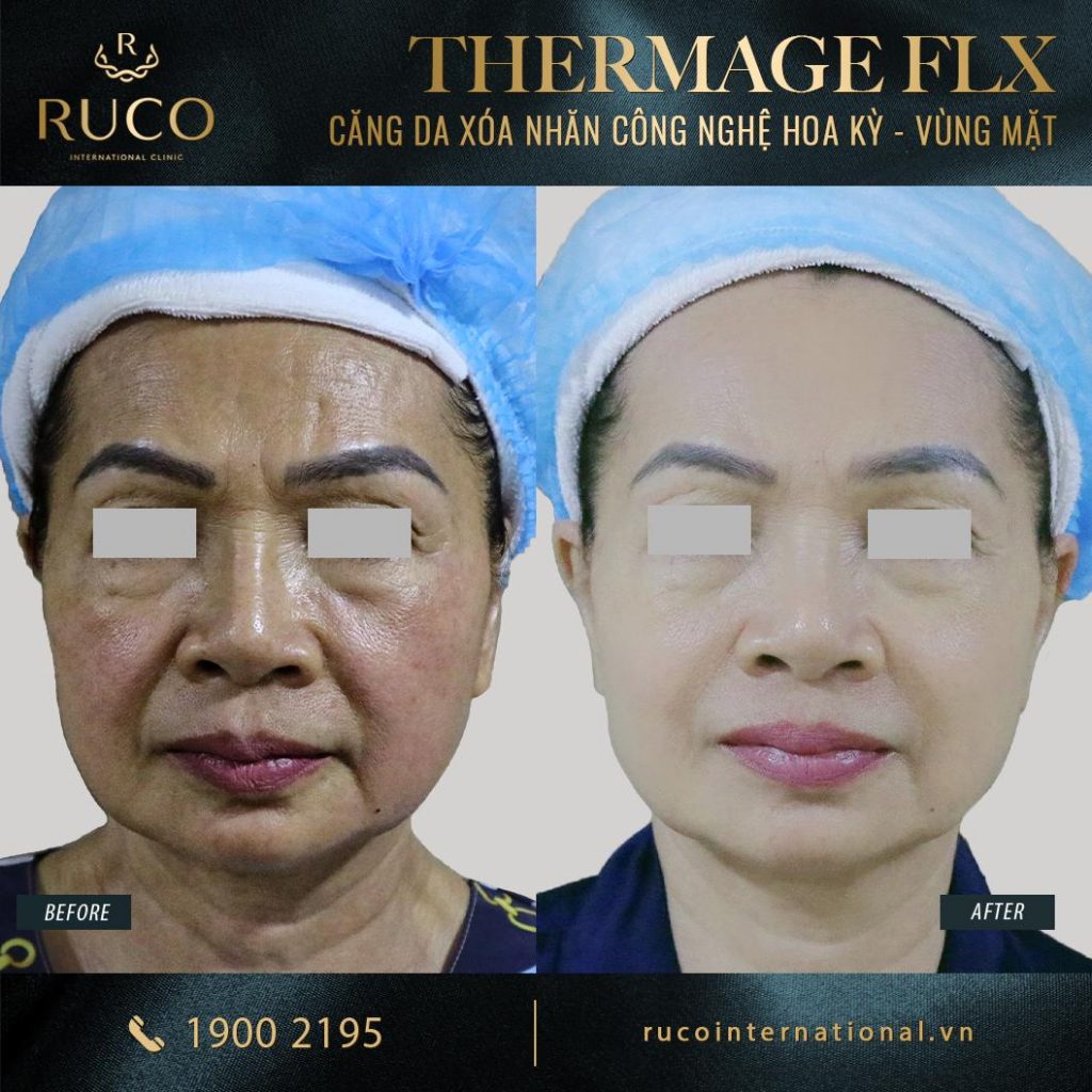thermage mặt thermage flx công nghệ hoa kỳ before after