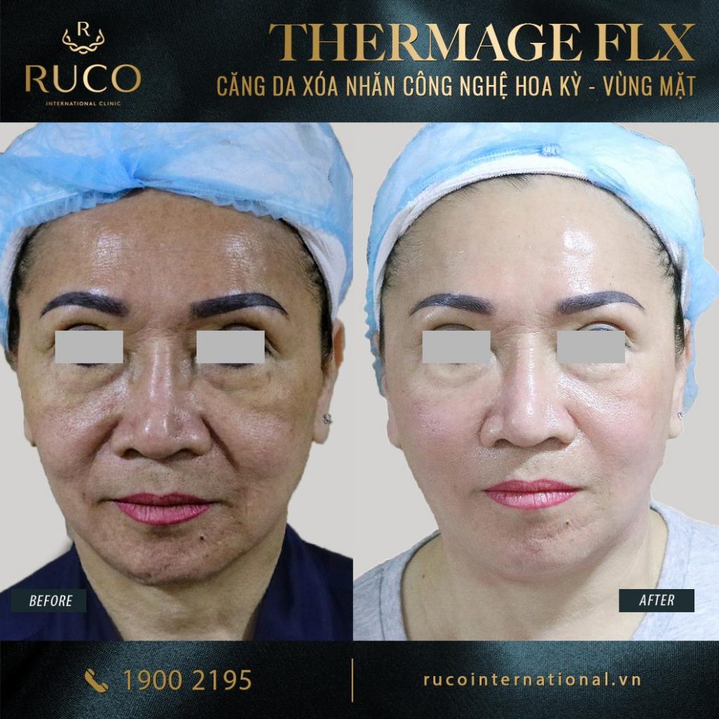 thermage mặt thermage flx công nghệ hoa kỳ before after 2