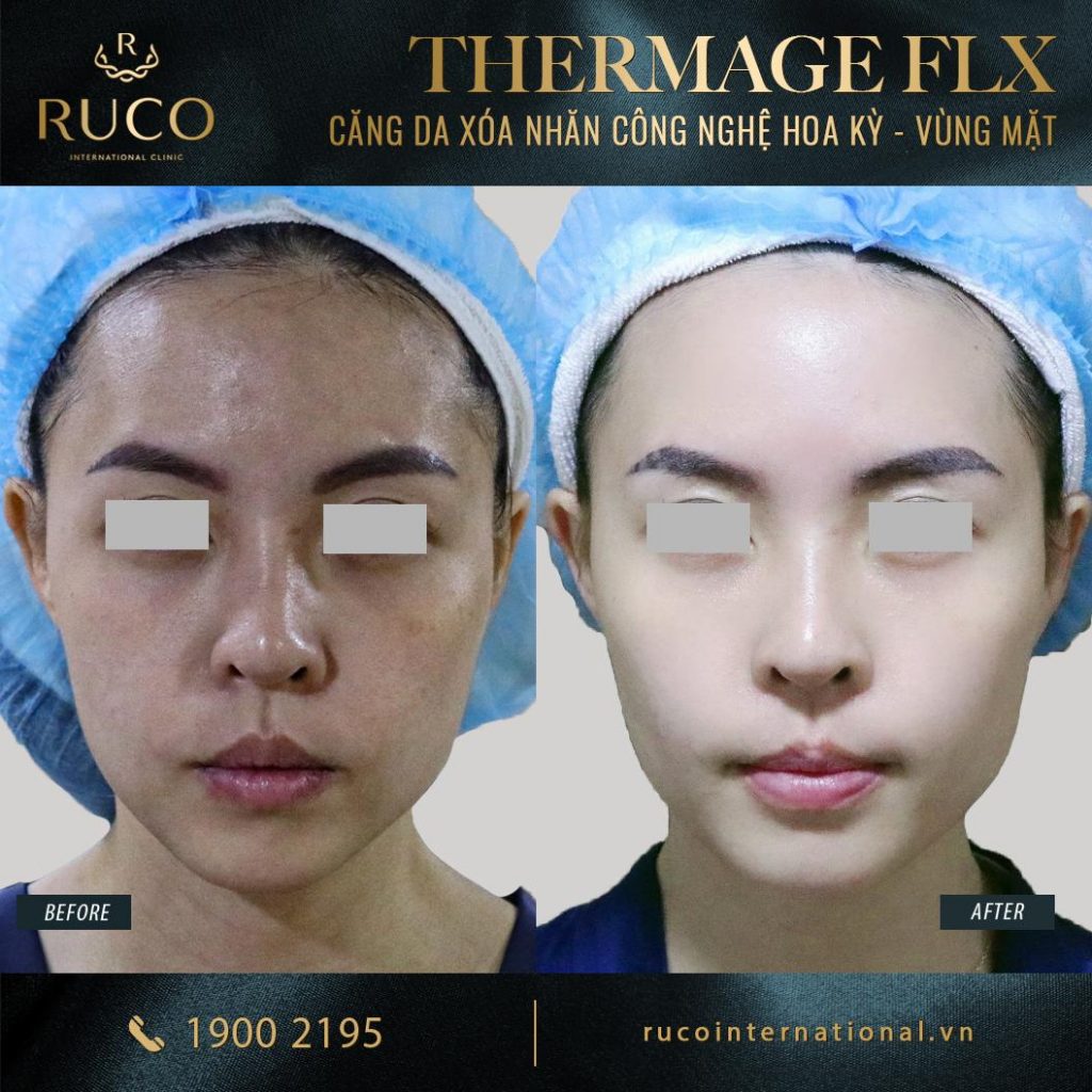 thermage mặt thermage flx công nghệ hoa kỳ before after 3