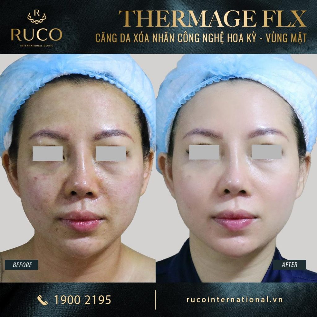 thermage mặt thermage flx công nghệ hoa kỳ before after 4