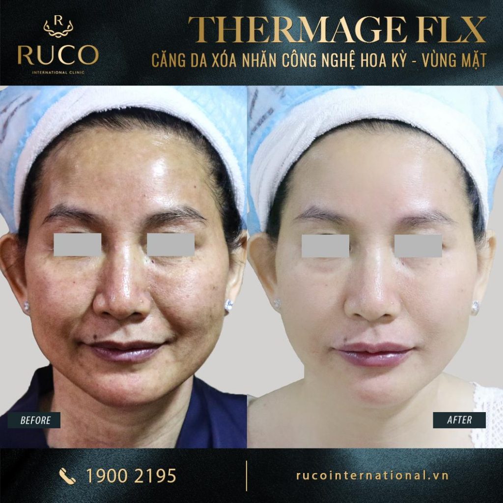 thermage mặt thermage flx công nghệ hoa kỳ before after 5