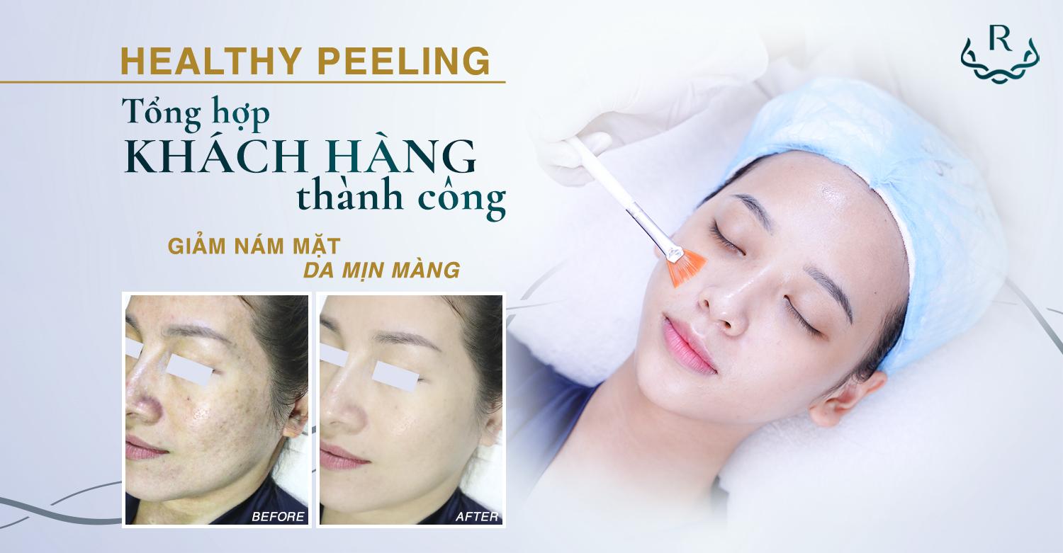Healthy Peeling - Giảm nám mặt da mịn màng