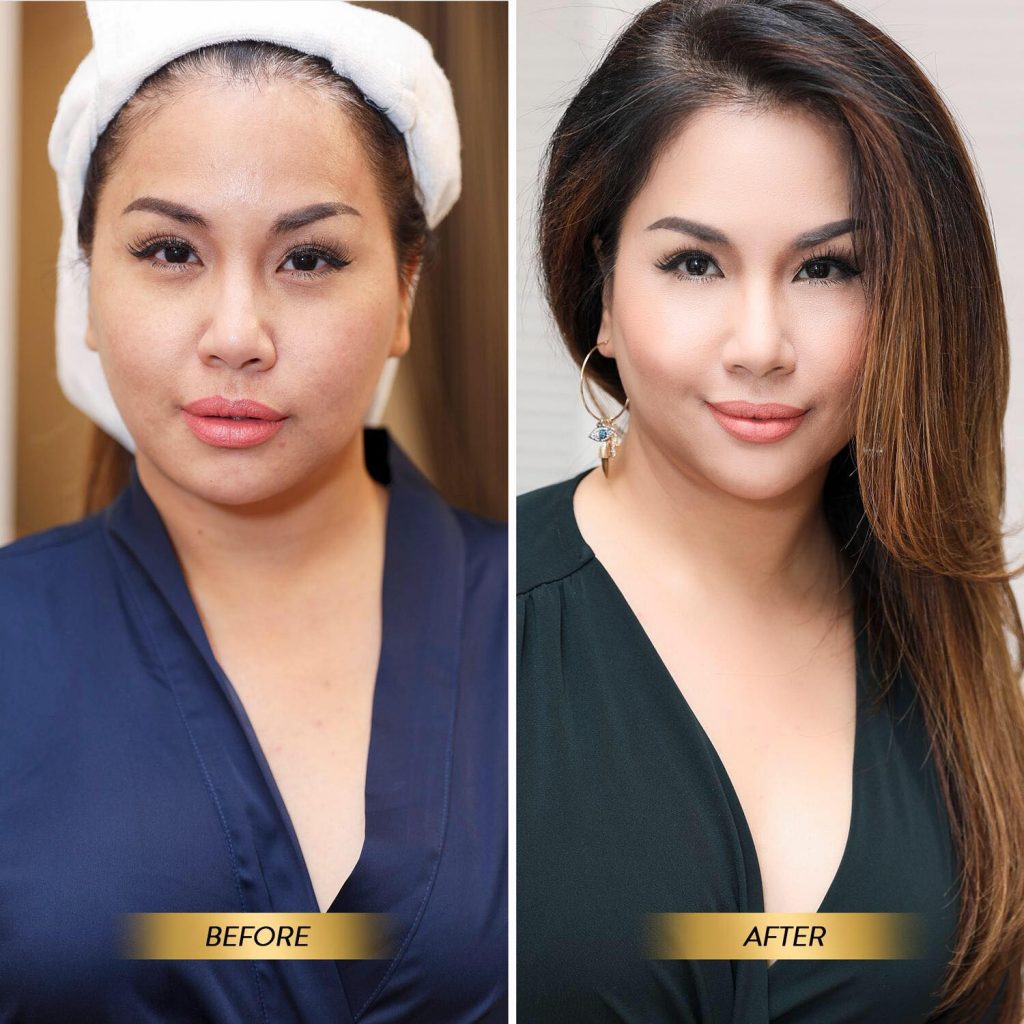 before after trẻ hóa ultherapy minh tuyết