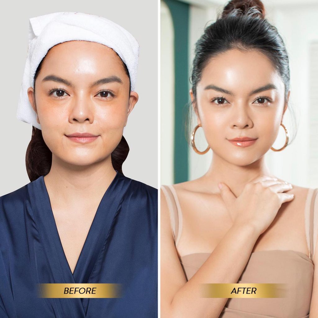 before after trẻ hóa ultherapy phạm quỳnh anh
