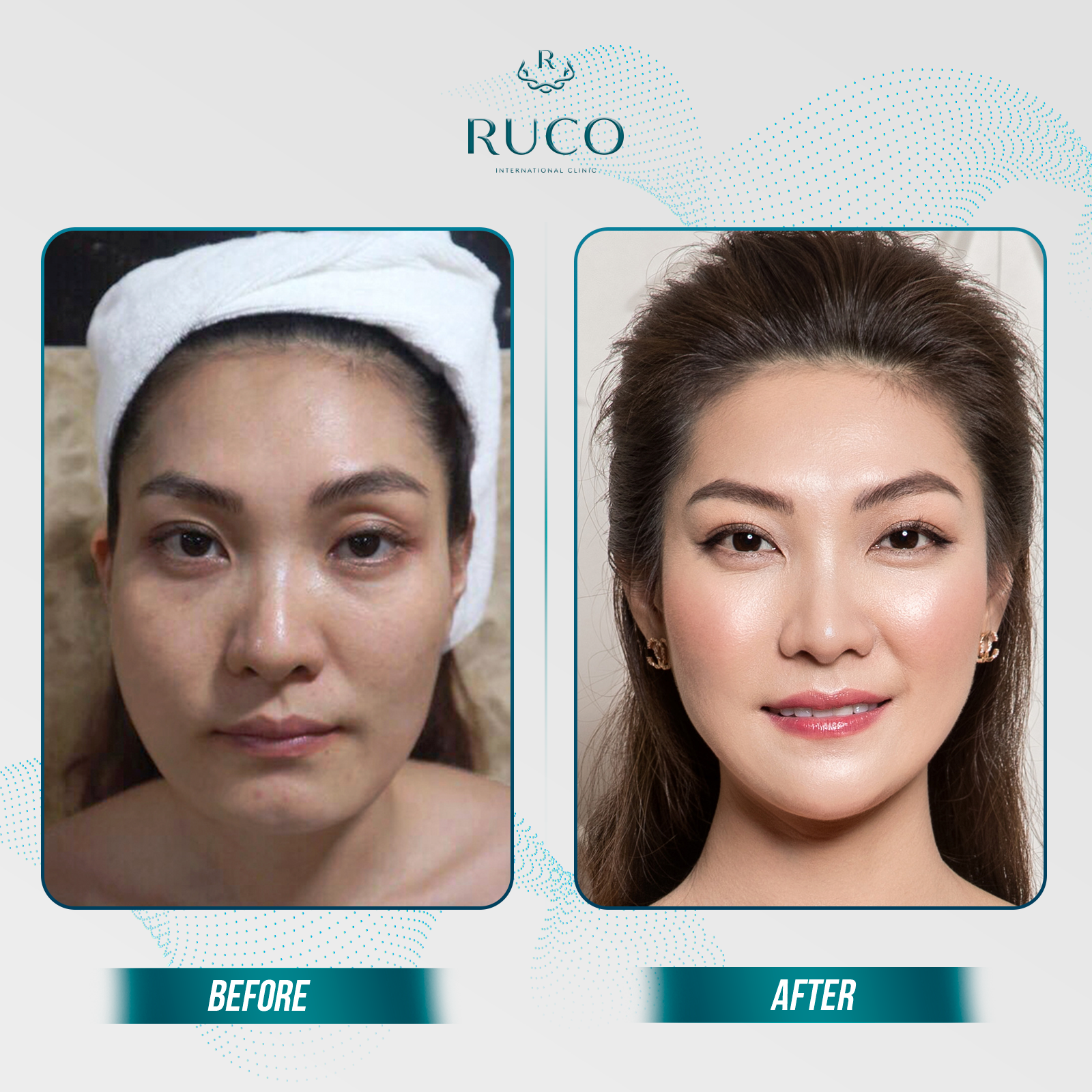 Sự thay đổi rõ rệt mà Luxury Skin mang lại cho khách hàng trải nghiệm tại RUCO.