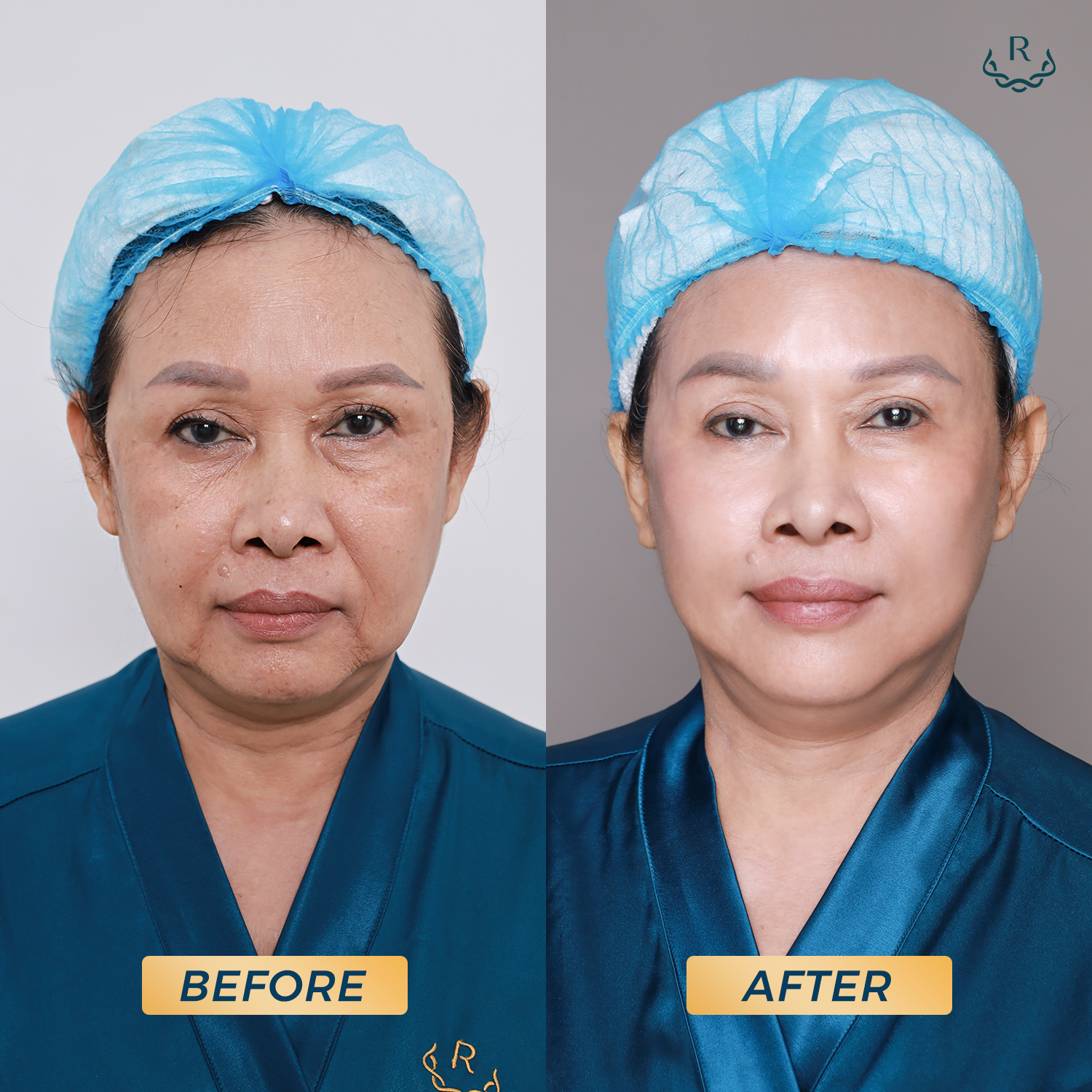 Hình ảnh khách hàng trước và sau khi Thực Hiện liệu trình Ultherapy - thermage FLX