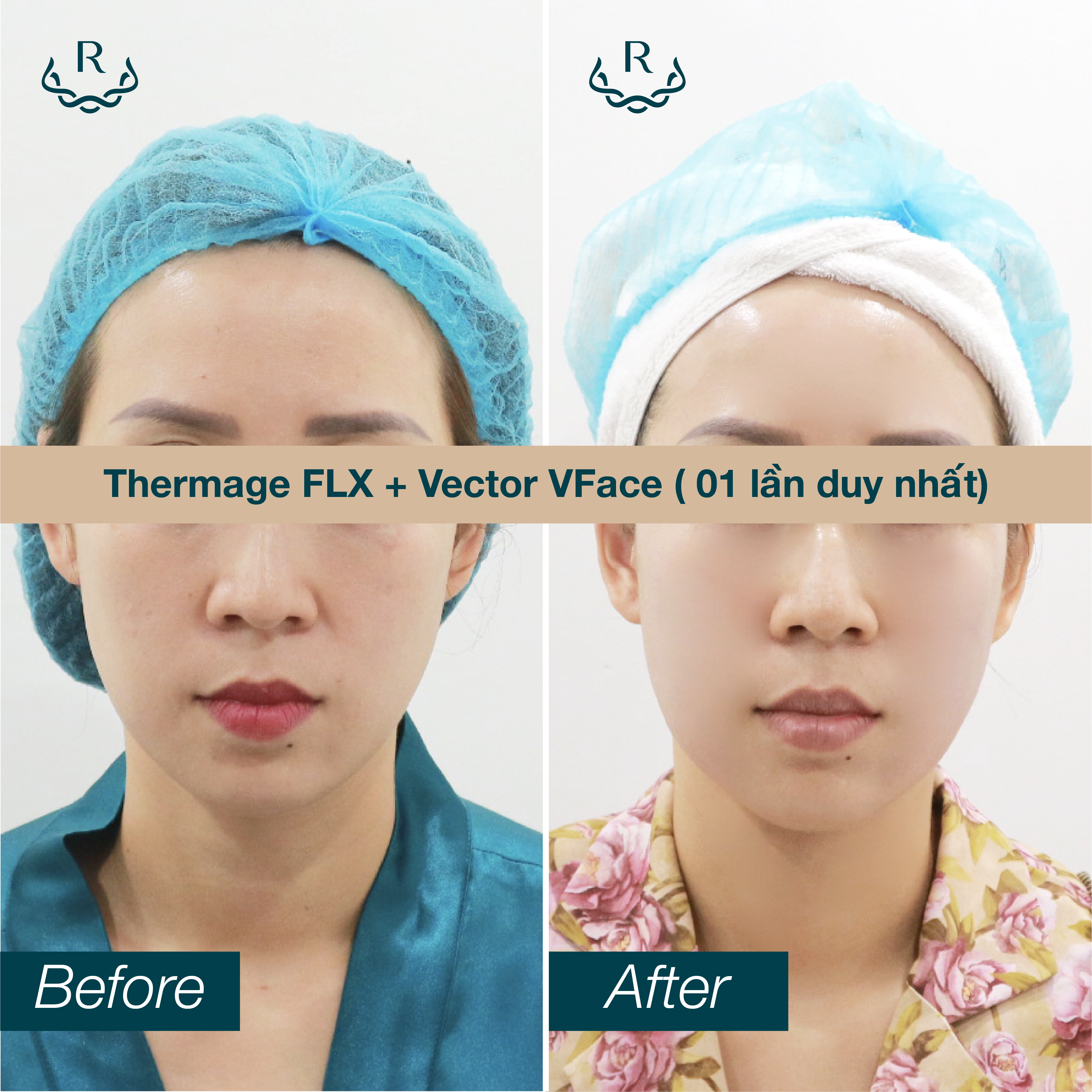 1 số case Thermage FLX + Vector V.Face thành công tại Ruco International Clinic.