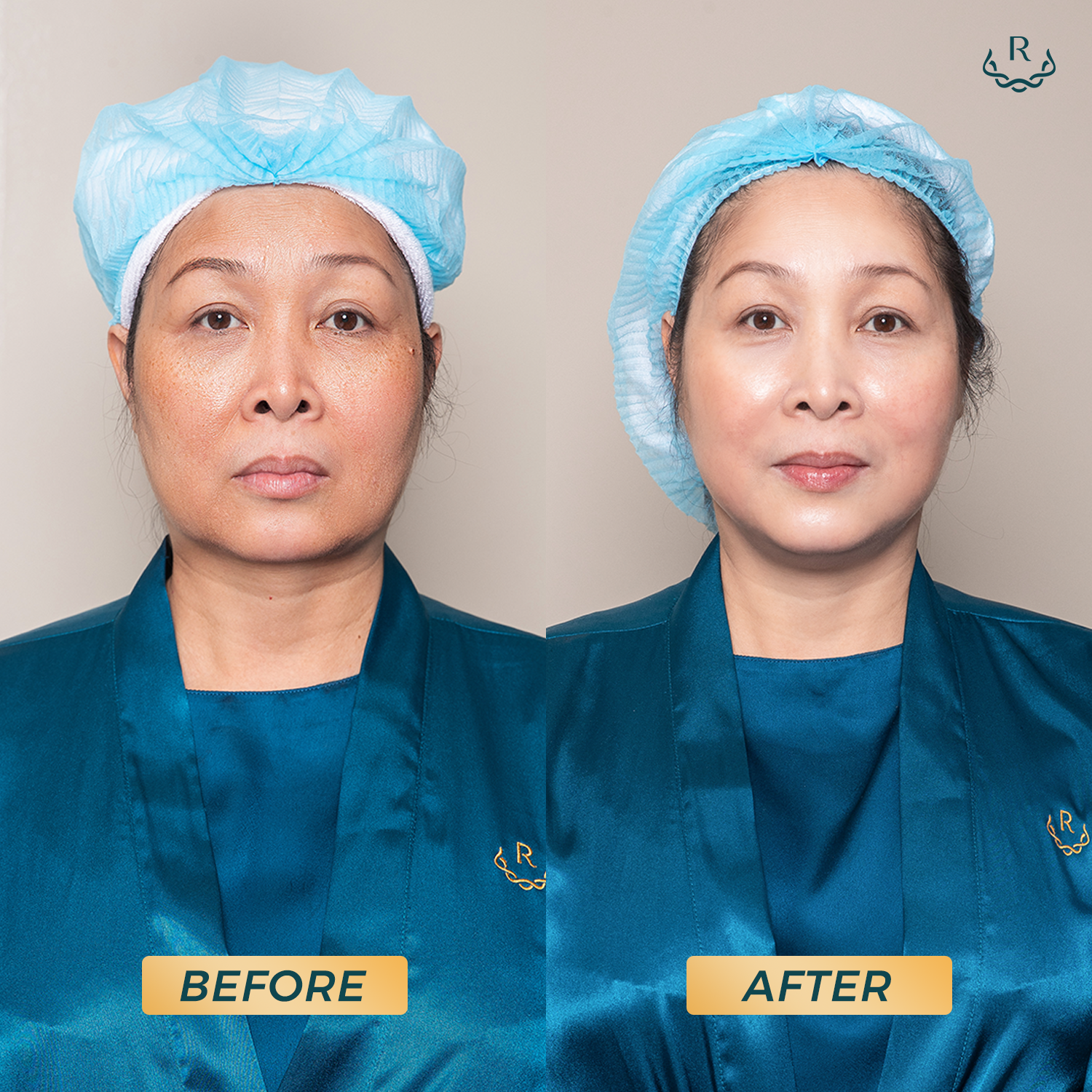 Hình ảnh trước và sau khi thực hiện liệu trình trẻ hóa da