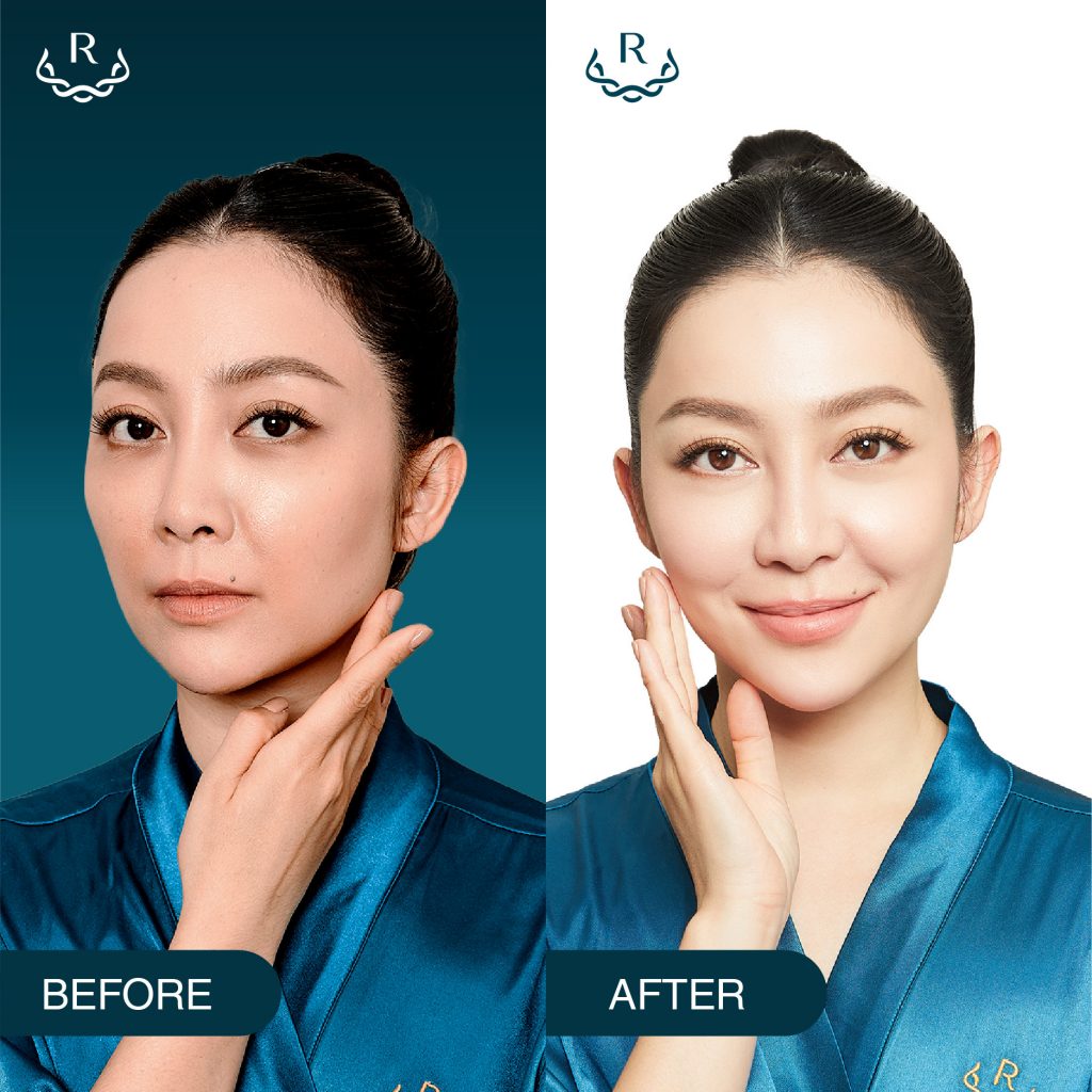 before after công nghệ trẻ hóa thermage flx ultherapy linh nga