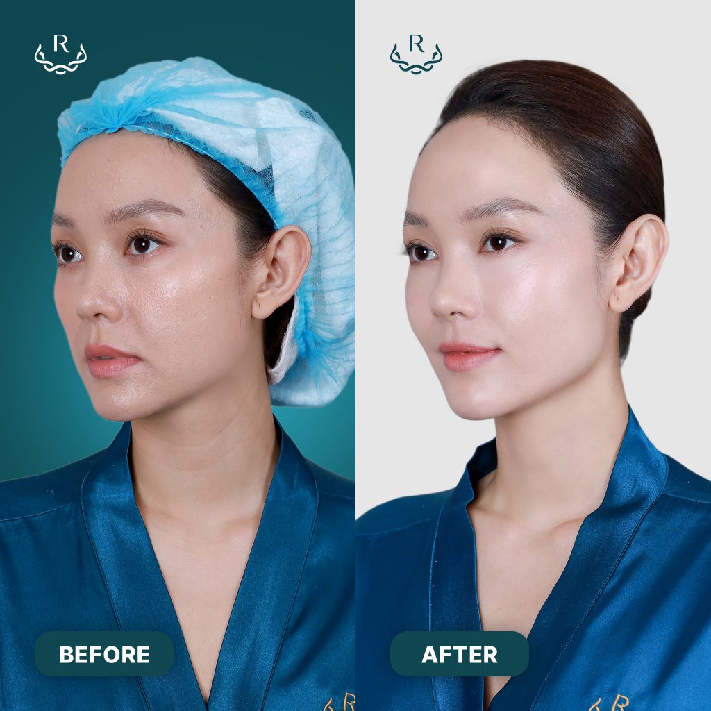 before after công nghệ trẻ hóa thermage flx ultherapy minh hằng