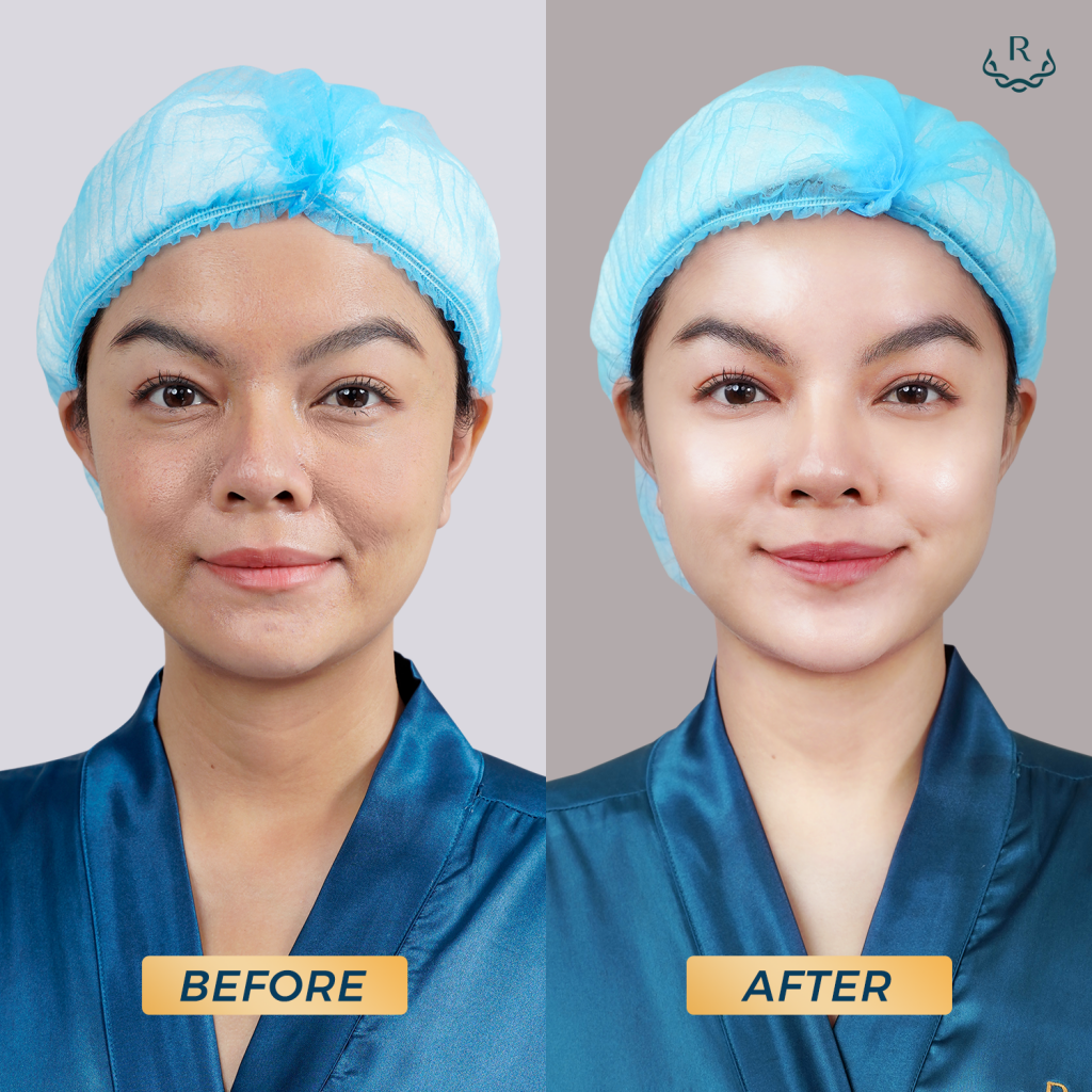 before after công nghệ trẻ hóa thermage flx ultherapy phạm quỳnh anh
