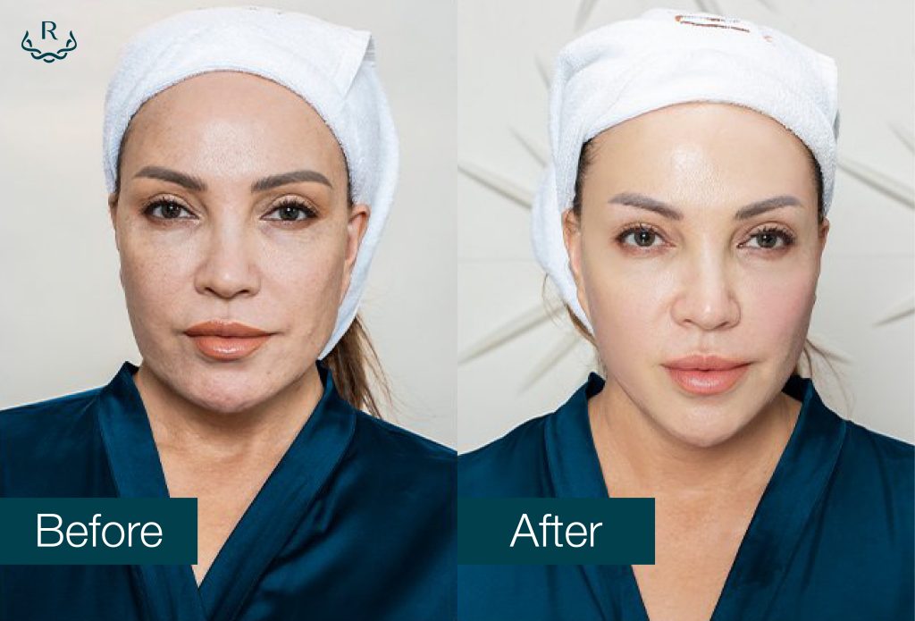before after công nghệ trẻ hóa thermage flx ultherapy thanh hà