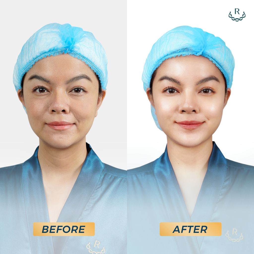 phạm quỳnh anh before after thermage flx ruco