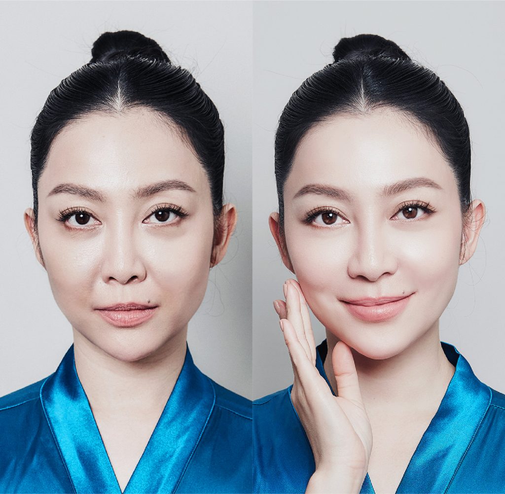ruco ultherapy trẻ hóa phạm quỳnh anh before after