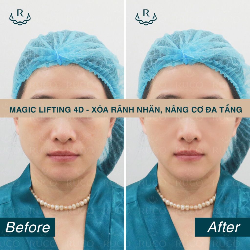 before after magic lifting 4d 2 - thermage x3
