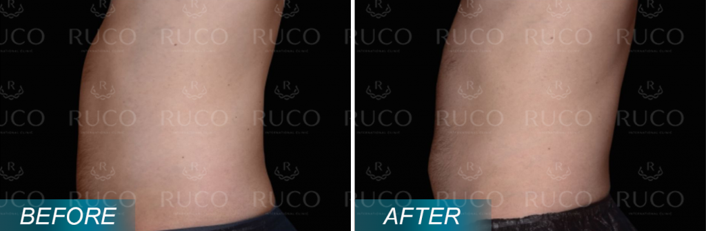 before after ruco 11fit
