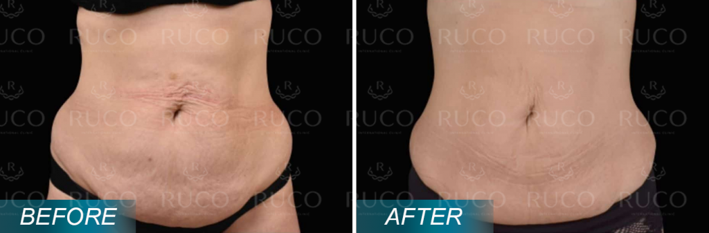 before after ruco 11fit 2 EmSculpt Neo