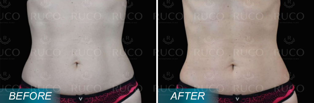 before after ruco 11fit EmSculpt Neo