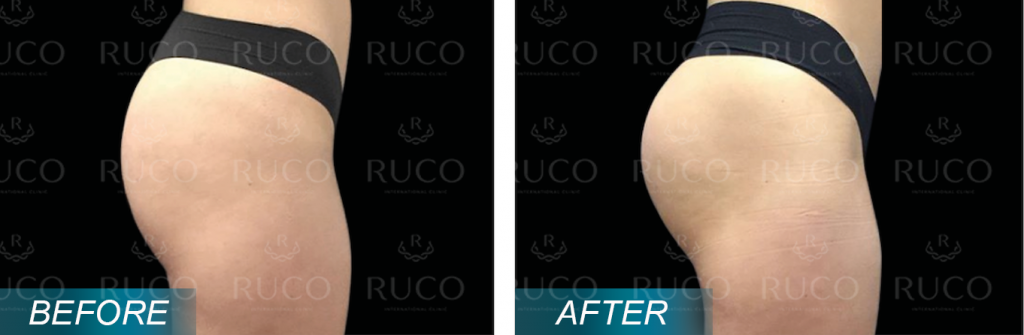 before after ruco 11fit bap chan - EmSculpt Neo
