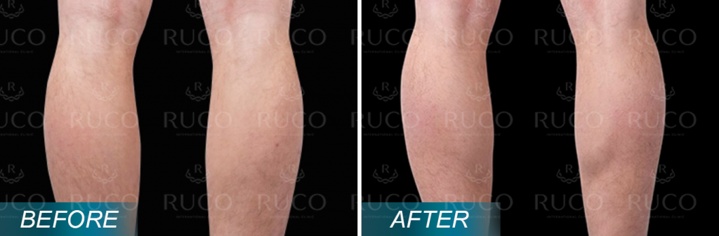 before after ruco 11 fit -EmSculpt Neo bap chan thon gon