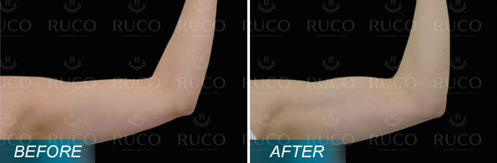 before after ruco 11fit canh tay EmSculpt Neo