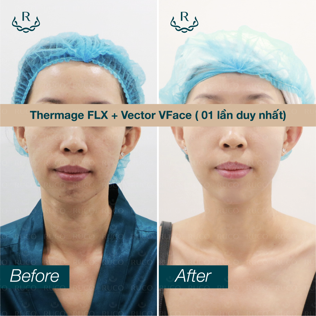 before after thermage flx vector vface 1 - thermage x3