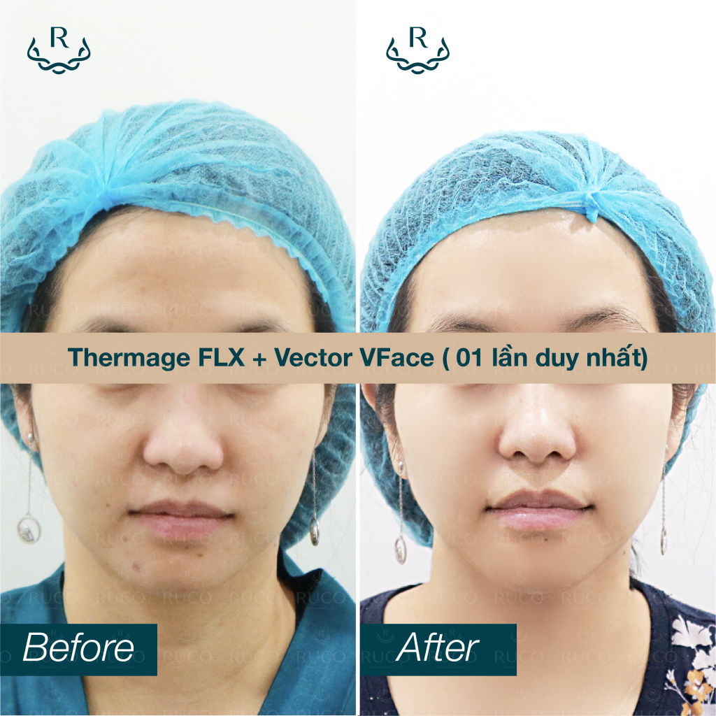 before after thermage flx vector vface 2