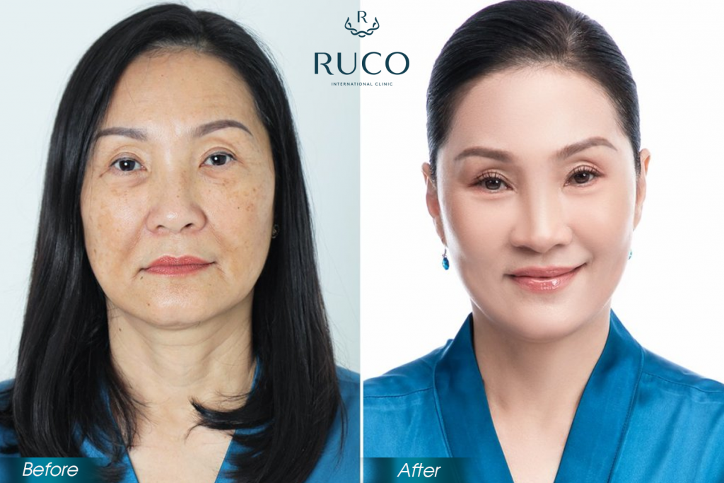 before after ultherapy ruco international clinic 1